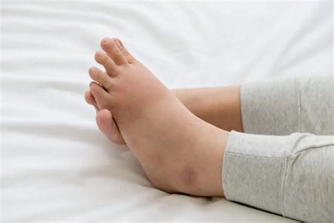 sarcina și oboseala varicoasă a picioarelor